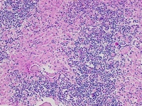 Gaucher's Disease: Trephine PAS 2