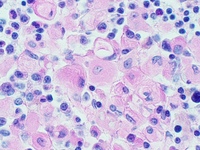 Gaucher's Disease: Trephine PAS 3