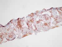 Gaucher's Disease: Trephine TRAP 1