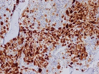 Gaucher's Disease: Trephine TRAP 2