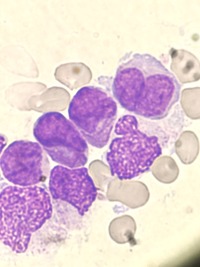 Hypogranular Promyelocytic Leukemia 2