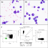 Malignant Plasma Cells in the CSF in Multiple Myeloma