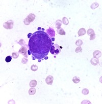 Giant Pronormoblast: A Hallmark of Parvovirus B19 Infection