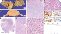 Primary colonic T-cell lymphoma with a TFH phenotype, favoring extranodal TFH lymphoma, angioimmunoblastic type