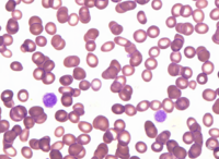 Giant platelets in Bernard-Soulier syndrome 1