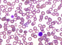 Giant platelets in Bernard-Soulier syndrome 2