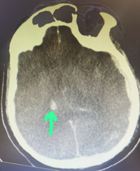 CT brain showed intracranial hemorrhage(arrow)