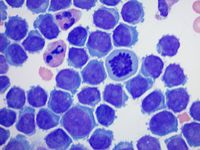 Myeloma in CSF high power