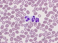 Capnocytophaga canimorsus sepsis