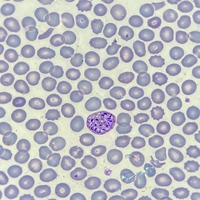 Plasmodium vivax schizont in peripheral blood smear (Field’s stain)