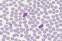 Plasmodium falciparum gametocytes in peripheral blood smear (Field stain, 100× oil immersion)