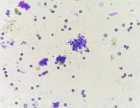 Cerebrospinal fluid cytospin showing extracellular budding yeast forms consistent with Candida species