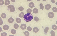 Basophil in Peripheral Blood Smear