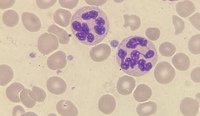Hypersegmented Neutrophils in Peripheral Blood Smear