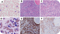 CD25 mast cell hyperplasia in myeloid/lymphoid neoplasm with PDGFRA rearrangement mimicking systemic mastocytosis