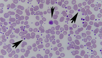 Giant Platelet in a Patient with Thrombocytosis
