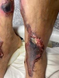 Dermal Thrombosis in a case of PNH