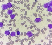 Acute myeloid leukemia with monocytic differentiation
