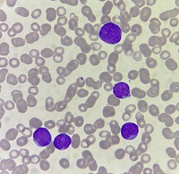 B-cell Acute Lymphoblastic Leukemia