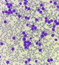 Acute monocytic leukemia
