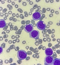 Acute monocytic leukemia