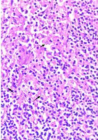 Primary bladder lymphoma with coexisting Malakoplakia