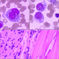 Rhabdomyosarcoma in bone marrow