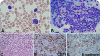 Pediatric acute erythroid leukemia with NUP98::KDM5A fusion