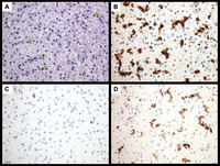 Microscopic image analysis of core liver biopsy