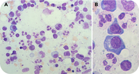 A WHIM of the marrow: myelokathexis as a cytological clue to a rare blood disorder
