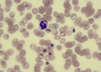 Pigment-laden neutrophil (malarial pigment)