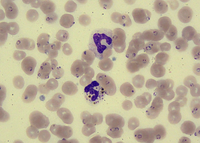 Pigment-laden neutrophil (malarial pigment)