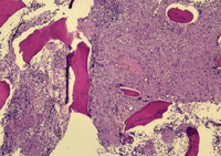 Foamy macrophages (storage cells) in bone marrow 1