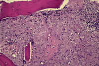 Foamy macrophages (storage cells) in bone marrow 2