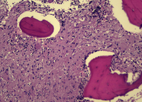 Foamy macrophages (storage cells) in bone marrow 3
