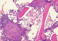 Caseating granuloma on bone marrow 1