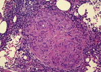 Caseating granuloma on bone marrow 2