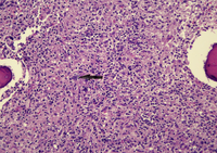 Hodgkin lymphoma on bone marrow biopsy 1