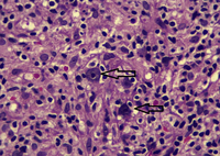 Hodgkin lymphoma on bone marrow biopsy 2