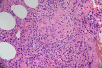 Bone marrow granuloma