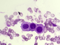 Reactive mesothelial cells in pericardial effusion 1