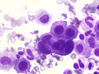 Reactive mesothelial cells in pericardial effusion 2