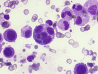 Reactive mesothelial cells in pericardial effusion 3