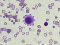 Reactive mesothelial cell in pericardial effusion 1