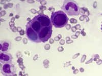 Reactive mesothelial cell in pericardial effusion 2