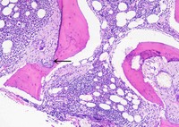 Bone trephine changes in hereditary hyperoxalosis 1