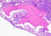 Bone trephine changes in hereditary hyperoxalosis 2