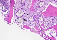 Hyperoxalosis (Crystals deposition) in bone trephine biopsy 1