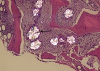 Hyperoxalosis (Crystals deposition) in bone trephine biopsy 2