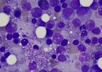 Hsitoplasmosis on bone marrow aspirate (Leishmann stain)